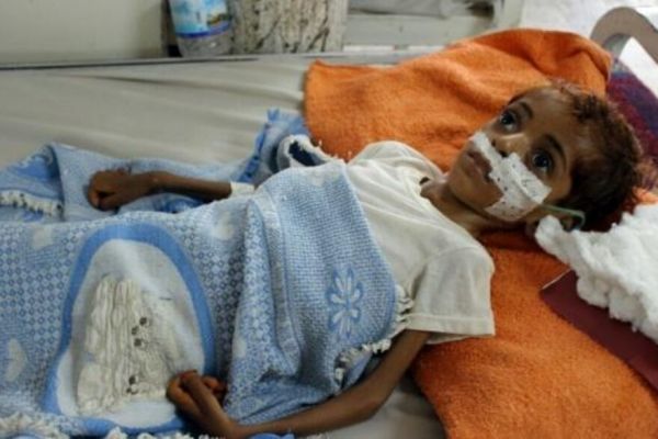 الصحة العالمية تقدم الدعم لوحدات الأطفال في 8 مستشفيات يمنية