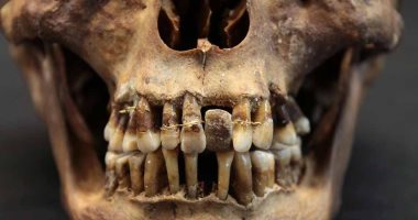 دراسة: إجراء تقويم أسنان في القرن الـ17 لحماية ابتسامة النخبة في فرنسا 