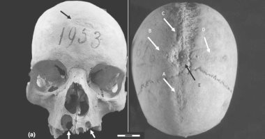 دراسة حديثة: امرأة من القرون الوسطى خضعت لجراحة في الجمجمة مرتين 
