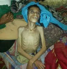 اليمن.. الجوع والمرض قد لا ينتظران السلام 